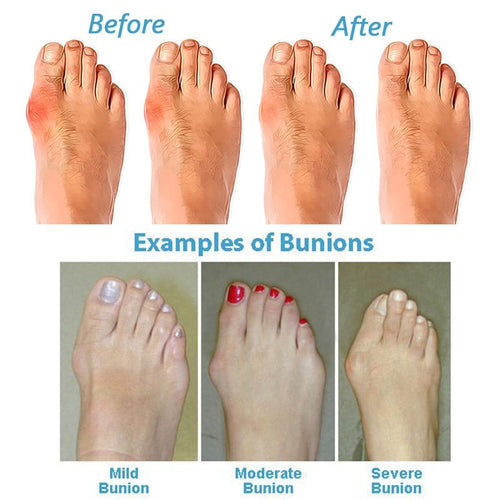 Lune London | Orthopedic Corrective Sandals